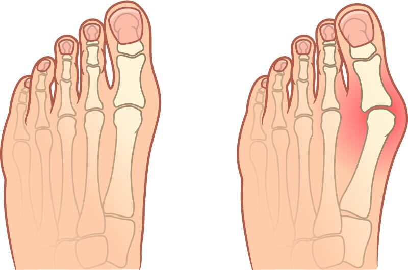 Вальгусная деформация стопы - Hallux Valgus